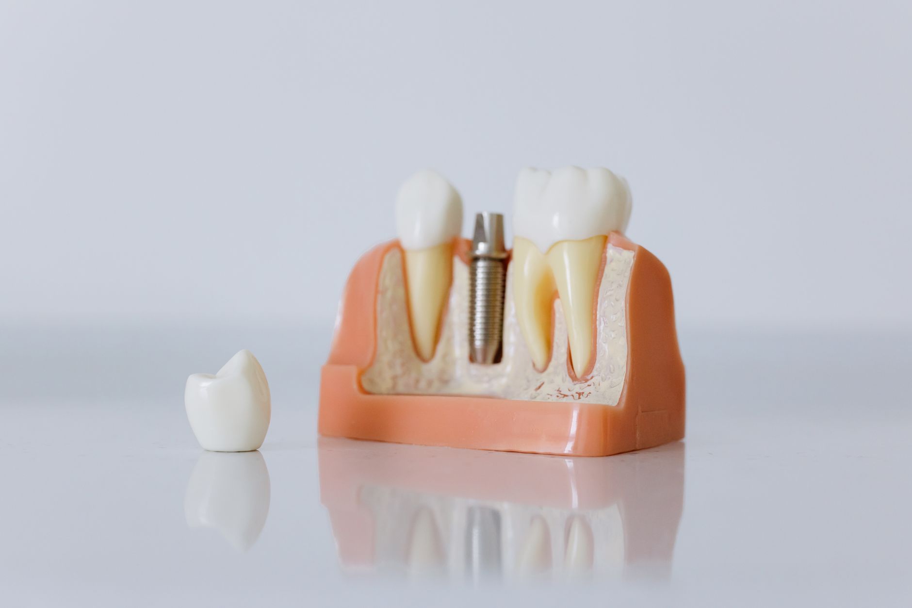 A cut-away teaching model showing an implant post sitting in the jawbone between two teeth, with a crown beside it